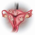How the fibroids procedure works First Step