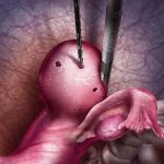 ACESSA Health procedure Fourth Step