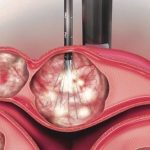 How the ACESSA procedure works Second Step