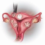 How the fibroids treatment works Third Step