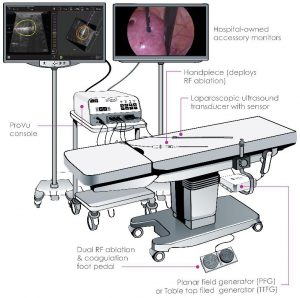 acessa fibroids procedure in maryland